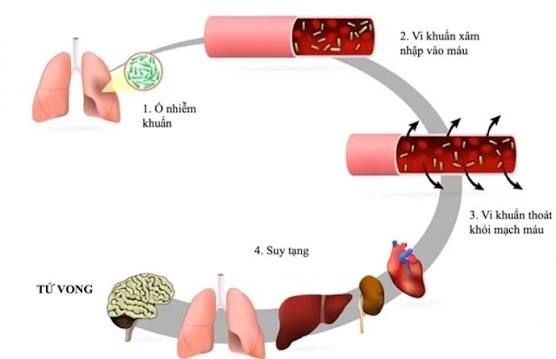 Nhiễm Trùng Máu: Dấu Hiệu Sốc Nhiễm Khuẩn, Chi Phí Điều Trị ICU & Bảo Hiểm