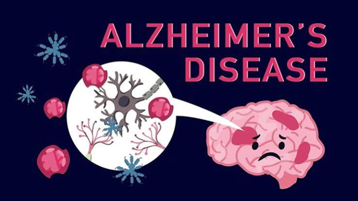 Bệnh Alzheimer: Dấu Hiệu Sớm, Chi Phí Chăm Sóc & Giải Pháp Bảo Hiểm