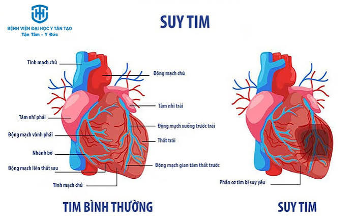 Suy Tim Mạn Tính: Chi Phí Điều Trị Và Giải Pháp Bảo Hiểm Tài Chính Lâu Dài