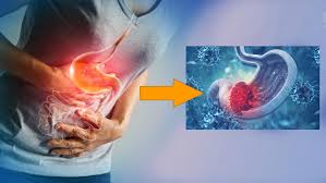 Ung thư dạ dày: thực trạng báo động và giải pháp bảo vệ sức khoẻ từ sớm
