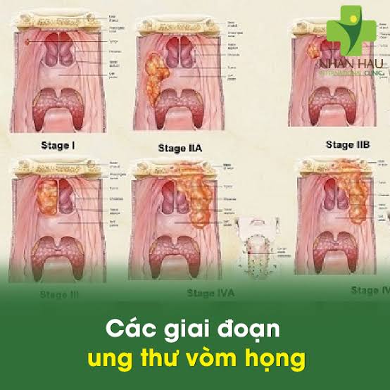 Ung Thư Vòm Họng: Nguyên Nhân, Dấu Hiệu Nhận Biết Sớm, Phương Pháp Điều Trị và Chi Phí