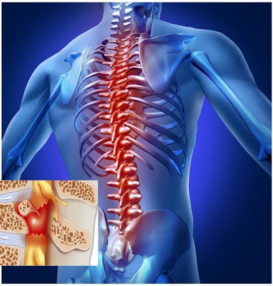 Tổn Thương Tủy Sống: Nguyên Nhân, Dấu Hiệu và Giải Pháp Tài Chính Từ Bảo Hiểm