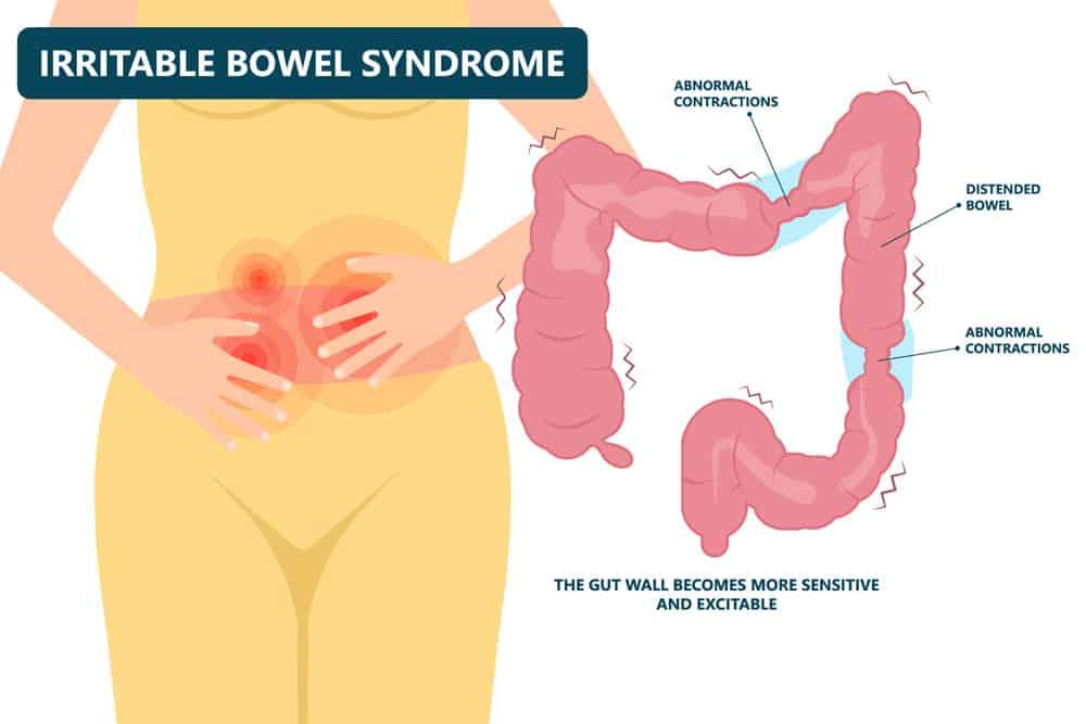 Viêm Đại Tràng Co Thắt Tái Phát (IBS): Cách Kiểm Soát & Giải Pháp Bảo Hiểm Dài Hạn