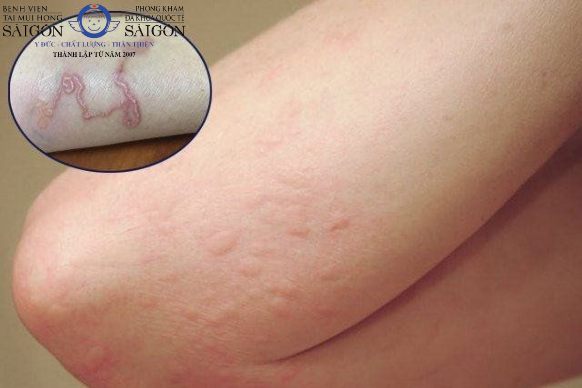 Bệnh Sán Chó: 15 Dấu Hiệu, Chi Phí Xét Nghiệm & Cách Phòng Tránh