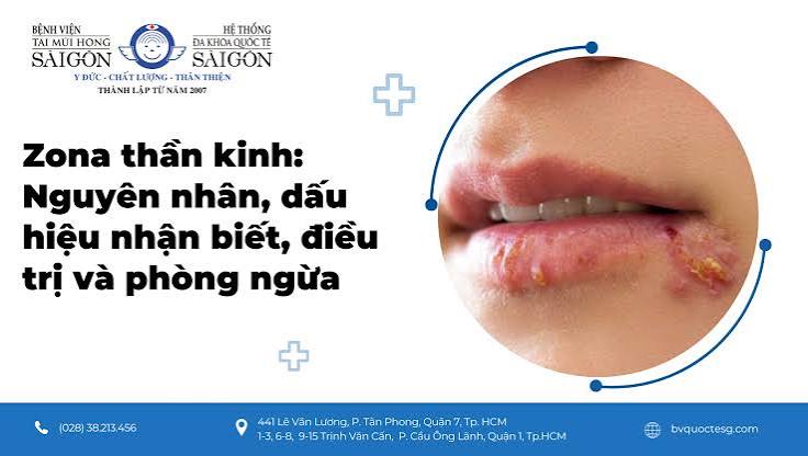 Zona Thần Kinh: Dấu Hiệu, Chi Phí Điều Trị & Bảo Hiểm Chi Trả | Dai-ichi Life