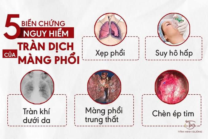 Tràn Dịch Màng Phổi: Triệu Chứng Khó Thở, Chi Phí Chọc Hút & Bảo Hiểm