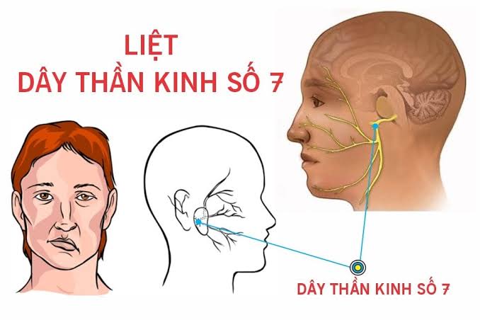 Liệt Dây Thần Kinh Số 7 (Liệt Mặt): Dấu Hiệu, Chi Phí và Giải Pháp Bảo Vệ Tài Chính