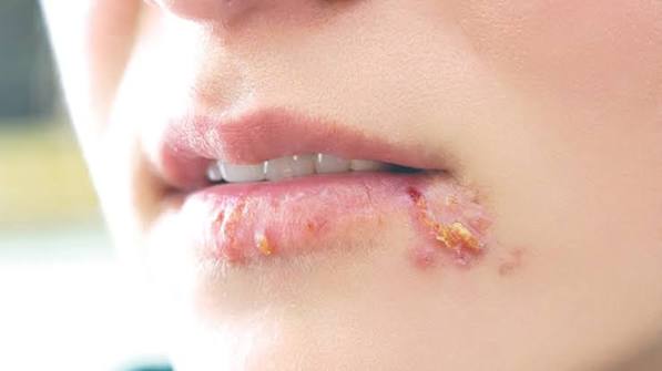 Herpes Môi: Dấu Hiệu Ngứa Rát, Cách Chữa Nhanh & Chi Phí Điều Trị